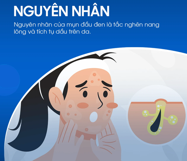 Kem gi&uacute;p ngừa mụn đầu đen cực đỉnh: Mũi sạch bong, căng b&oacute;ng như vừa đi spa - Ảnh 3.