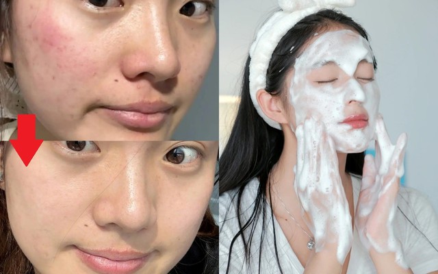 +7 sữa rửa mặt cho da dầu mụn sạch s&acirc;u m&agrave; &lsquo;&ecirc;m dịu&rsquo; ngừa mụn hiệu quả - Ảnh 1.