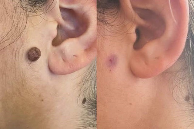 Sẹo thâm do tẩy nốt ruồi mãi không hết: Chuyên gia nói gì về cách cải thiện? - Ảnh 1.