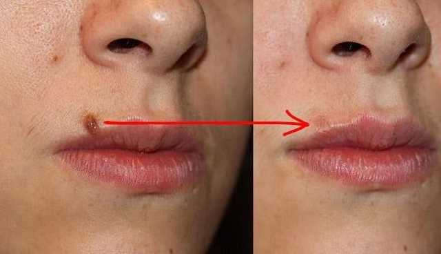 Sẹo thâm do tẩy nốt ruồi mãi không hết: Chuyên gia nói gì về cách cải thiện? - Ảnh 2.