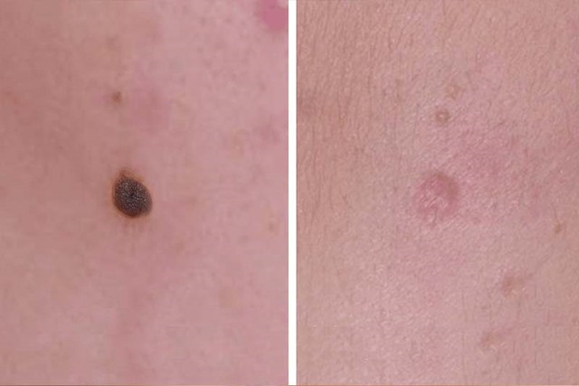 Sẹo thâm do tẩy nốt ruồi mãi không hết: Chuyên gia nói gì về cách cải thiện? - Ảnh 3.