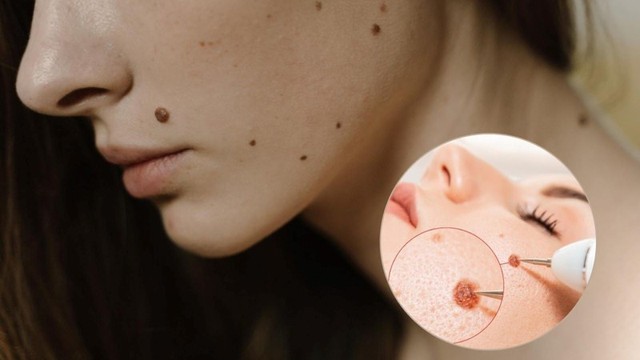 Sẹo thâm do tẩy nốt ruồi mãi không hết: Chuyên gia nói gì về cách cải thiện? - Ảnh 4.