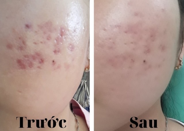 Sẹo th&acirc;m c&oacute; tự hết được kh&ocirc;ng? 99% đều tiếc v&igrave; biết điều n&agrave;y qu&aacute; muộn! - Ảnh 1.