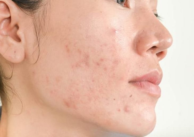 Sẹo th&acirc;m c&oacute; tự hết được kh&ocirc;ng? 99% đều tiếc v&igrave; biết điều n&agrave;y qu&aacute; muộn! - Ảnh 2.