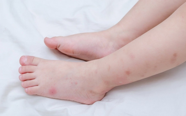 Sẹo th&acirc;m c&oacute; tự hết được kh&ocirc;ng? 99% đều tiếc v&igrave; biết điều n&agrave;y qu&aacute; muộn! - Ảnh 4.