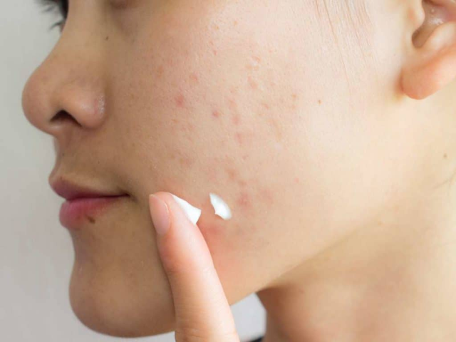 Sẹo th&acirc;m c&oacute; tự hết được kh&ocirc;ng? 99% đều tiếc v&igrave; biết điều n&agrave;y qu&aacute; muộn! - Ảnh 5.