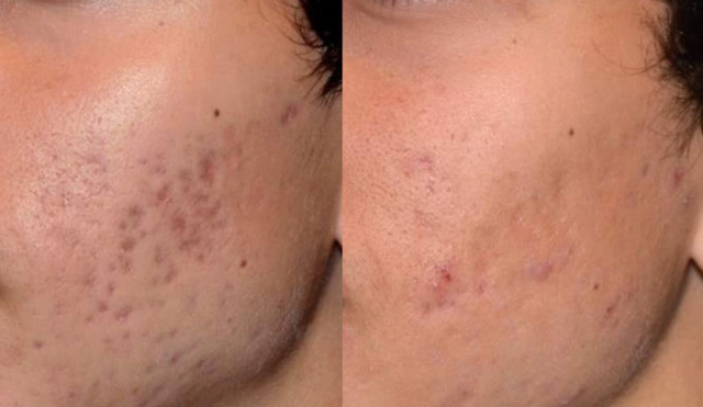 Sẹo th&acirc;m c&oacute; tự hết được kh&ocirc;ng? 99% đều tiếc v&igrave; biết điều n&agrave;y qu&aacute; muộn! - Ảnh 6.