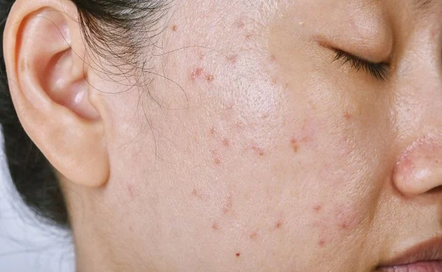 Sữa rửa mặt n&ecirc;n c&oacute; trong routine da dầu mụn của Trioderma?  - Ảnh 1.
