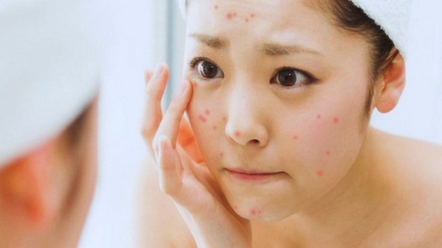 Nắng n&oacute;ng 40 độ: Đừng để kem chống nắng biến th&agrave;nh &lsquo;kẻ th&ugrave;&rsquo; g&acirc;y mụn ẩn - Ảnh 2.