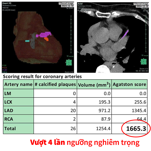 Dự b&aacute;o nguy cơ tim mạch 10 năm: Bước tiến mới của y học ứng dụng AI - Ảnh 2.
