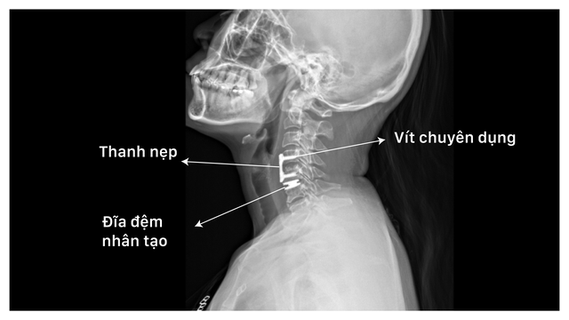 Tưởng đau cổ vai g&aacute;y, kh&ocirc;ng ngờ tủy sống bị ch&egrave;n &eacute;p v&igrave; tho&aacute;t vị đĩa đệm - Ảnh 3.