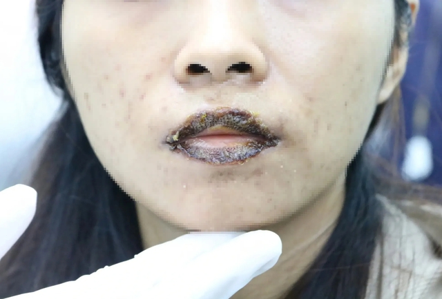 Bệnh viện Da liễu TP.HCM: 16% biến chứng thẩm mỹ li&ecirc;n quan thiết bị năng lượng- Ảnh 1.