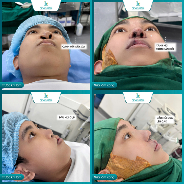 ThS-BS L&ecirc; Viết Tr&iacute; chia sẻ ba giải ph&aacute;p chỉnh sửa mũi m&ocirc;i dị tật - Ảnh 2.