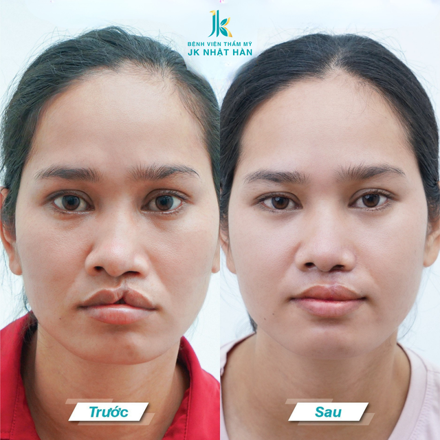 ThS-BS L&ecirc; Viết Tr&iacute; chia sẻ ba giải ph&aacute;p chỉnh sửa mũi m&ocirc;i dị tật - Ảnh 3.