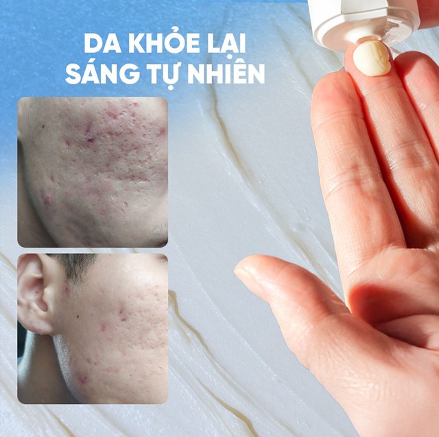 Review chi tiết kem Scar Esthetique làm mờ sẹo rỗ do mụn có tốt không?- Ảnh 1.