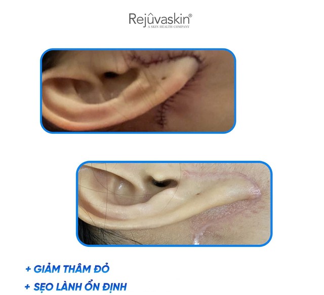 Kem gi&uacute;p mờ sẹo lồi Rejuvasil c&oacute; hiệu quả kh&ocirc;ng m&agrave; được chuy&ecirc;n gia tin d&ugrave;ng?- Ảnh 4.