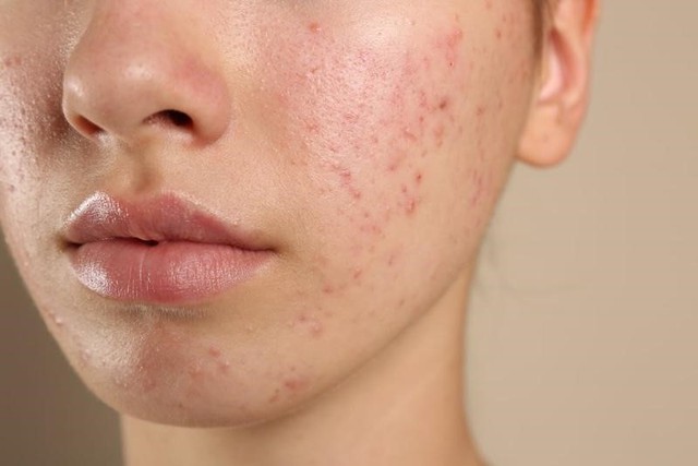 Kh&aacute;ng kh&aacute;ng sinh trong điều trị mụn v&agrave; giải ph&aacute;p thay thế từ tia Plasma lạnh- Ảnh 1.