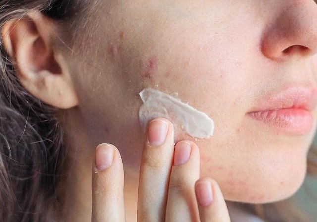 Kh&aacute;ng kh&aacute;ng sinh trong điều trị mụn v&agrave; giải ph&aacute;p thay thế từ tia Plasma lạnh- Ảnh 2.