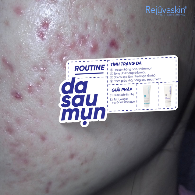 V&igrave; sao skincare rất nhiều nhưng da sau mụn vẫn kh&ocirc;ng đẹp l&ecirc;n? - Ảnh 4.