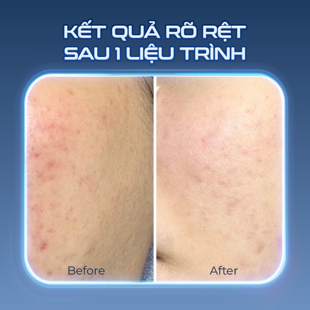 Kh&aacute;ng kh&aacute;ng sinh trong điều trị mụn v&agrave; giải ph&aacute;p thay thế từ tia Plasma lạnh- Ảnh 4.