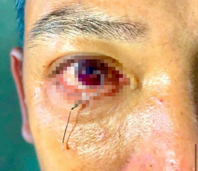 Cấp cứu bệnh nh&acirc;n bị lưỡi c&acirc;u ghim v&agrave;o mắt - Ảnh 1.