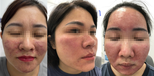 BS.CKII Nguyễn Tiến Thành: Chuyên gia điều trị biến chứng da- Ảnh 1. BS.CKII Nguyễn Tiến Thành: Chuyên gia điều trị biến chứng da- Ảnh 1.