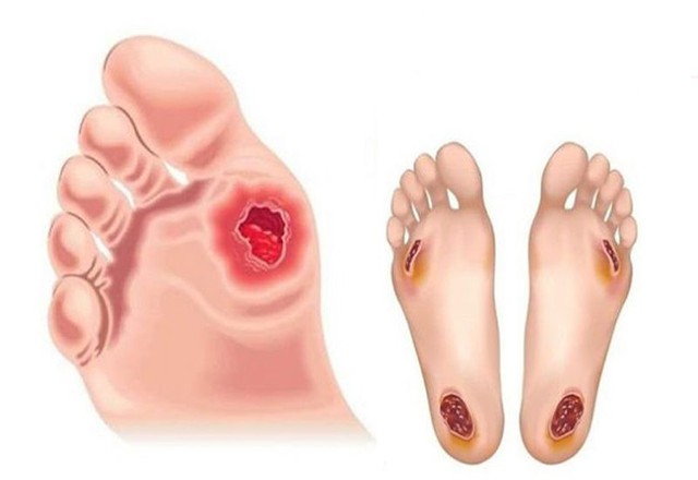 Vết loét lâu lành và nguy cơ hoại tử, dừng ngay việc tự xử lý tại nhà- Ảnh 2. Vết loét lâu lành và nguy cơ hoại tử, dừng ngay việc tự xử lý tại nhà- Ảnh 2.