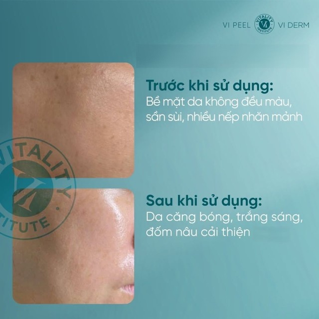Mua retinol tiền triệu m&agrave; da vẫn xấu chỉ v&igrave; c&aacute;ch sử dụng retinol chưa đ&uacute;ng- Ảnh 9.