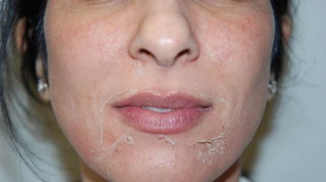 Mua retinol tiền triệu m&agrave; da vẫn xấu chỉ v&igrave; c&aacute;ch sử dụng retinol chưa đ&uacute;ng- Ảnh 2.