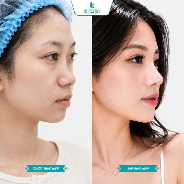 X&oacute;a mũi tẹt cho thanh thiếu ni&ecirc;n Việt - Trao cơ hội n&acirc;ng mũi miễn ph&iacute;- Ảnh 1.
