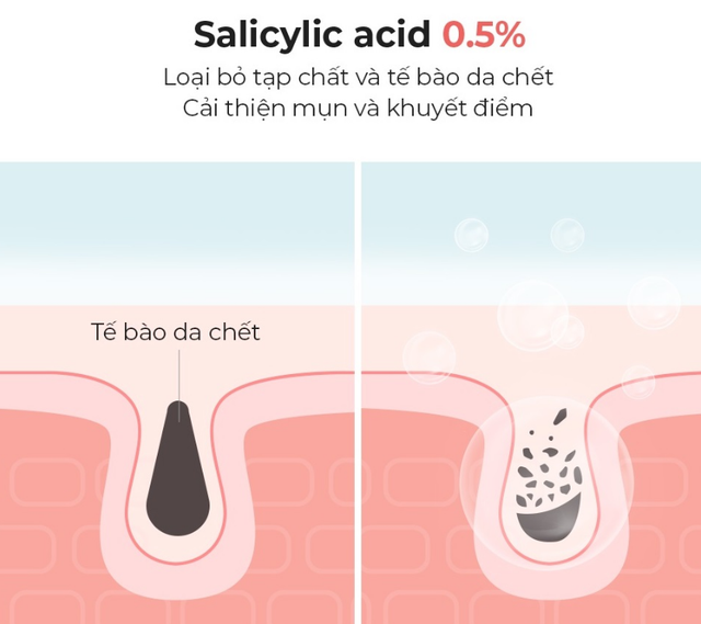 Salicylic acid là gì mà chuyên gia da liễu luôn khuyên dùng cho da dầu mụn? - Ảnh 4.