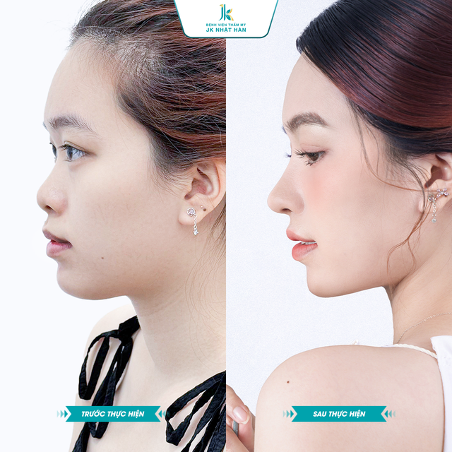 X&oacute;a mũi tẹt cho thanh thiếu ni&ecirc;n Việt - Trao cơ hội n&acirc;ng mũi miễn ph&iacute;- Ảnh 4.