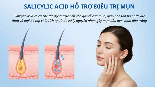 Salicylic acid là gì mà chuyên gia da liễu luôn khuyên dùng cho da dầu mụn? - Ảnh 5.