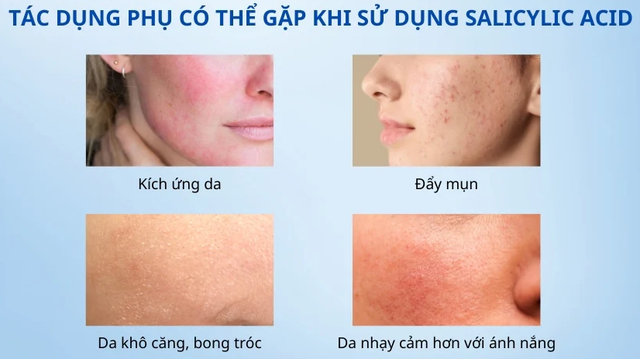 Salicylic acid là gì mà chuyên gia da liễu luôn khuyên dùng cho da dầu mụn? - Ảnh 9.