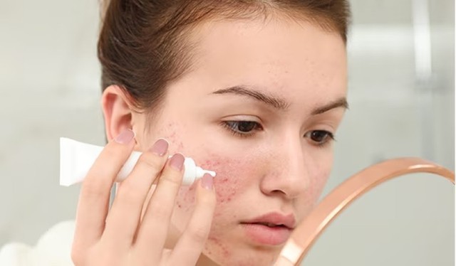 Cách chọn kem chấm mụn chuẩn y khoa cho da láng mịn, mờ thâm sau 2 tuần - Ảnh 2.
