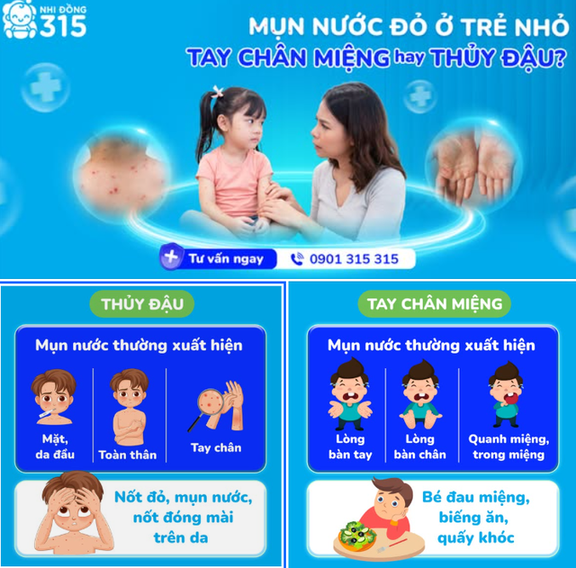 Làm sao phân biệt mụn nước và thủy đậu? - Ảnh 1.