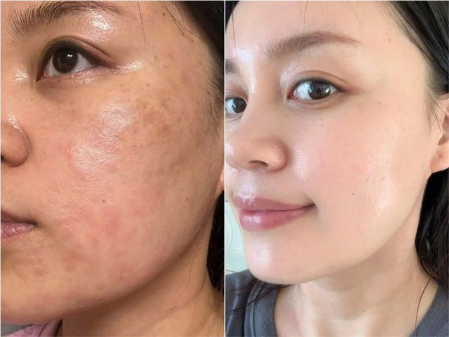 Da dầu mụn mùa nắng nóng ‘mê mẩn’ sản phẩm phục hồi này vì không bí da - Ảnh 1.