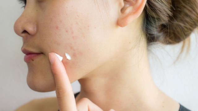 Da dầu mụn mùa nắng nóng ‘mê mẩn’ sản phẩm phục hồi này vì không bí da - Ảnh 2.