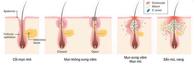 Gel chấm mụn nên dùng khi nào? Những lưu ý trước khi chấm mụn - Ảnh 1.