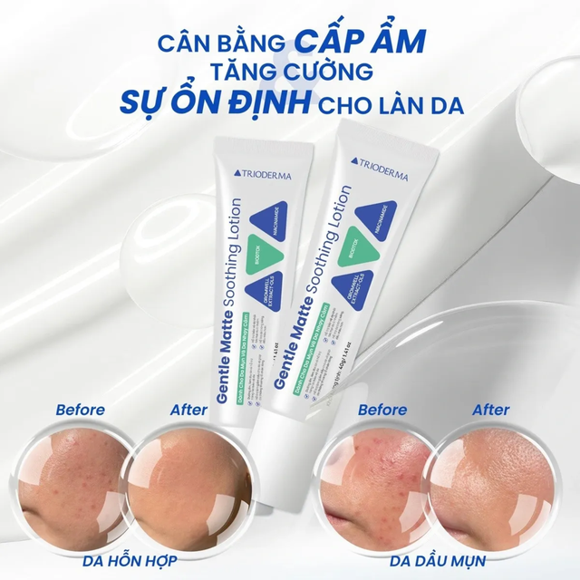 Gel chấm mụn nên dùng khi nào? Những lưu ý trước khi chấm mụn - Ảnh 4.