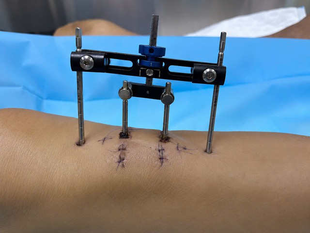 Phương pháp mới giúp bệnh nhân tiểu đường thoát nguy cơ đoạn chi tại FV - Ảnh 2.