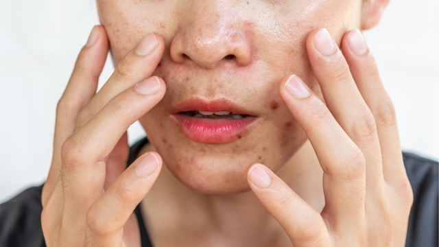 Da dầu mụn mãi không hết? Nhiều người mắc cùng một sai lầm khiến mụn tái phát - Ảnh 2.