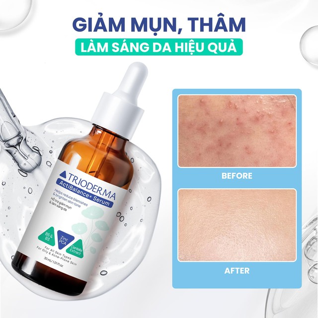 Da dầu mụn mãi không hết? Nhiều người mắc cùng một sai lầm khiến mụn tái phát - Ảnh 5.