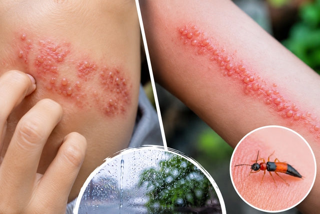 Nổi mụn nước, bỏng r&aacute;t tr&ecirc;n da: L&agrave;m sao biết do zona hay kiến ba khoang? - Ảnh 1.