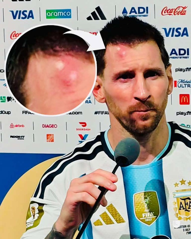 Messi sưng v&ecirc;u tr&aacute;n sau trận thắng Cabo Verde: V&igrave; sao n&ecirc;n nỗi?- Ảnh 1.