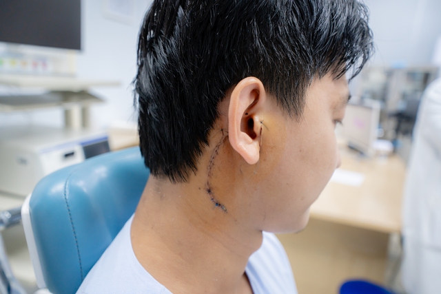 Hơn 20 năm không điều trị khối u vùng dưới tai vì nỗi lo liệt mặt - Ảnh 2.