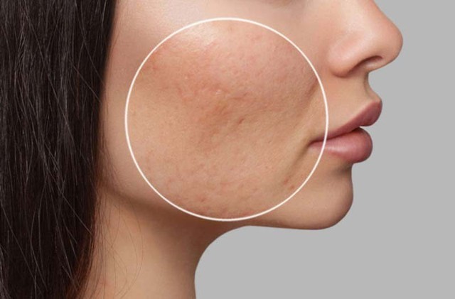 Sẹo thủy đậu c&oacute; tự hết kh&ocirc;ng? C&aacute;ch mờ sẹo sau 4 tuần, kể cả l&acirc;u năm - Ảnh 3.