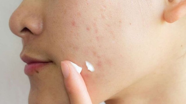 Sẹo thủy đậu c&oacute; tự hết kh&ocirc;ng? C&aacute;ch mờ sẹo sau 4 tuần, kể cả l&acirc;u năm - Ảnh 5.