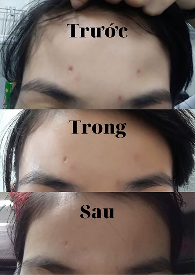Sẹo thủy đậu c&oacute; tự hết kh&ocirc;ng? C&aacute;ch mờ sẹo sau 4 tuần, kể cả l&acirc;u năm - Ảnh 8.