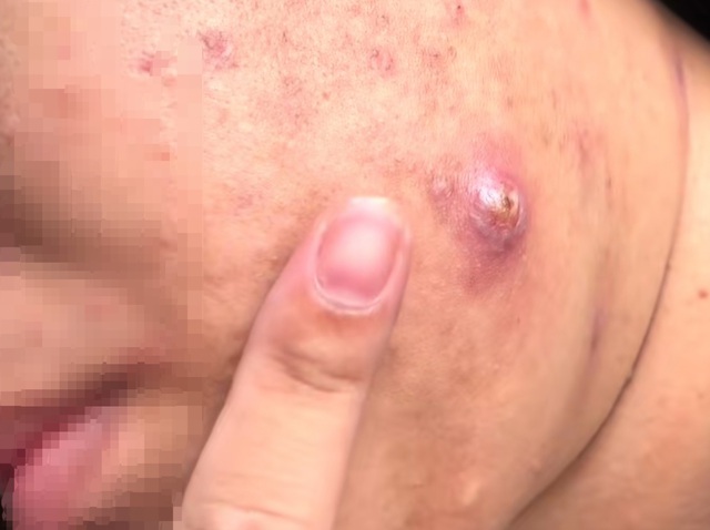 Nổi mụn đầu đinh: V&igrave; sao b&aacute;c sĩ khuy&ecirc;n tuyệt đối kh&ocirc;ng tự nặn? - Ảnh 1.